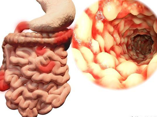 它与普通结肠炎相比有何不同之处?一文科普