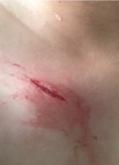 肉裂开的愈合方法需根据伤口类型及程度采取不同