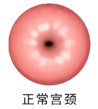 宫颈不大是好还是不好