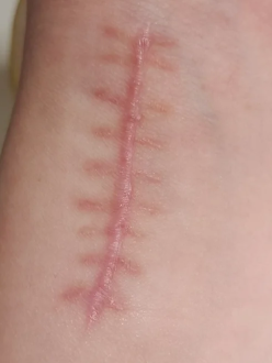 缝针疤痕几年后会淡化