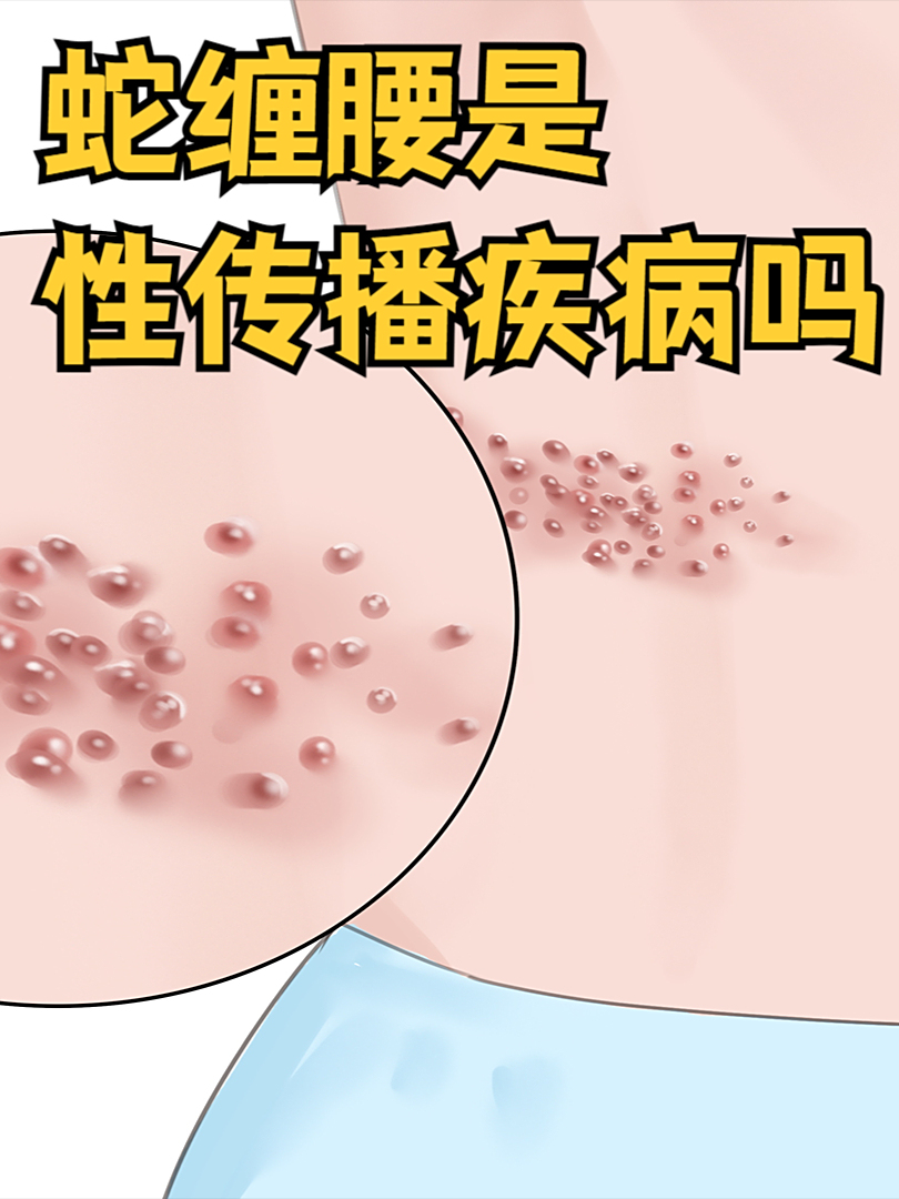 蛇缠腰是性传染的病吗?