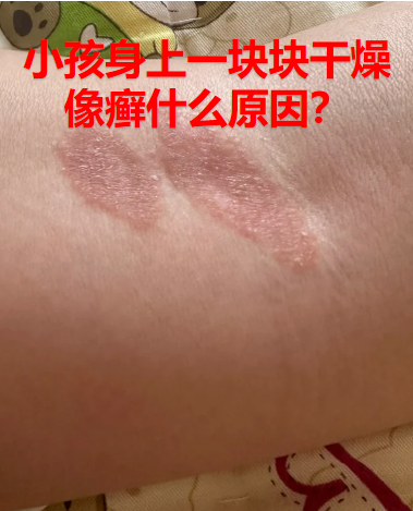 干燥,空气湿度低,或长时间处于空调,暖气环境中,导致皮肤水分流失加快