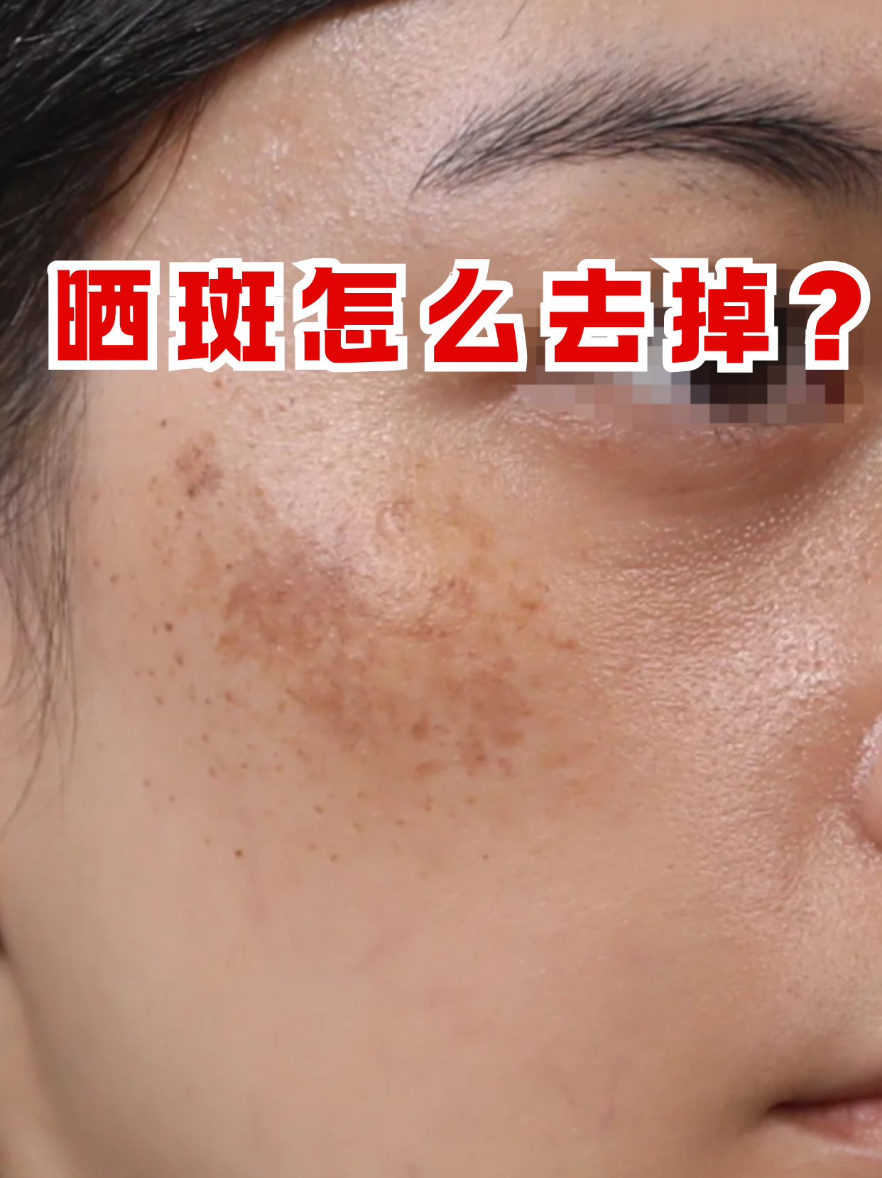 晒斑可以通过防晒,外用药物,医美,生活调理等方法去掉