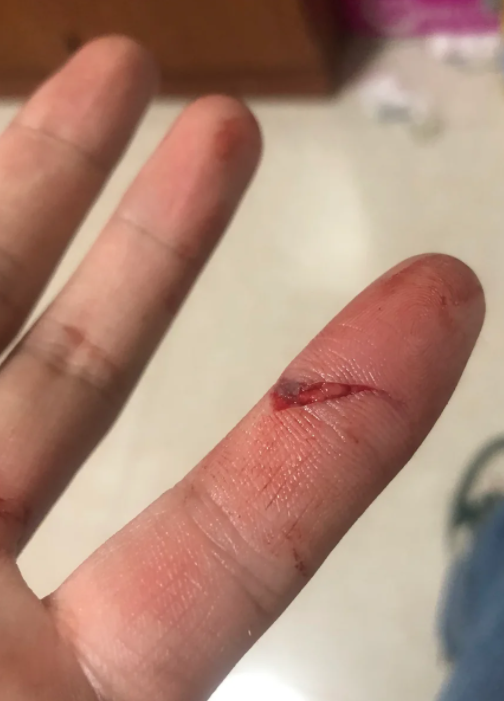 手指被划伤了然后很痒什么原因