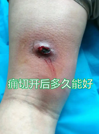 如使用头孢外伤口组织坏死图片手术伤口留引流口痈切开引流后怎么换药