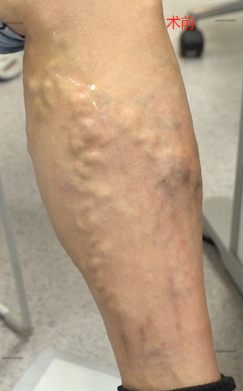 因为看过我科普账号的文章,了解到usg联合微创不