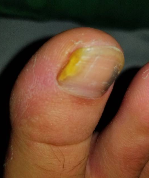 大脚趾指甲变黄变空里面发臭什么原因