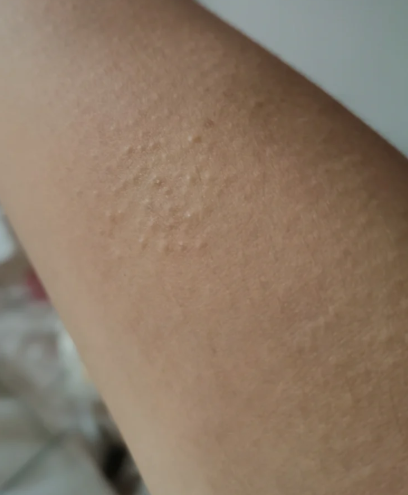 身上起鸡皮疙瘩很痒怎么回事