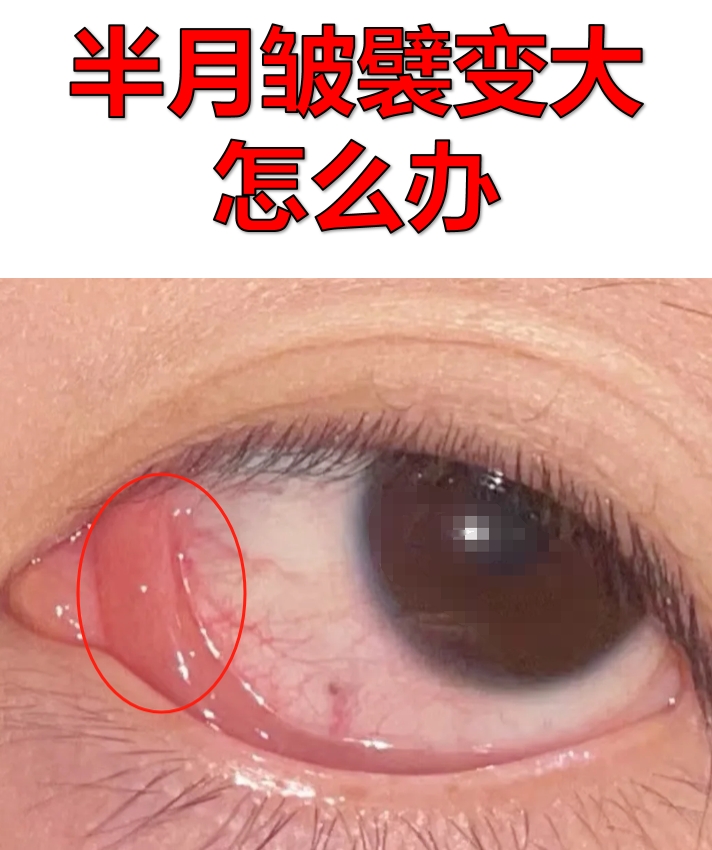 半月皱襞变大,一般是指结膜半月皱襞变大,这可能与过度用眼,不良