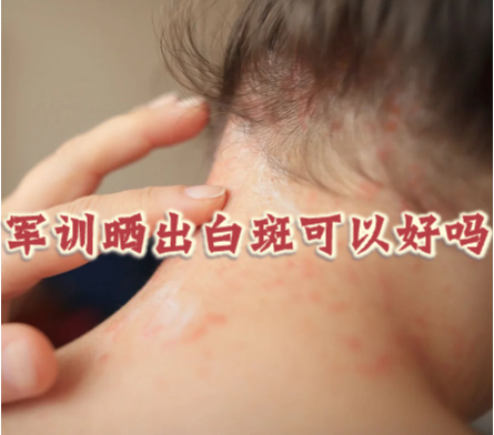 军训晒出白斑可以好吗