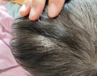 包括白色糠疹,头癣,白癜风,花斑癣,银屑病,外伤后色素减退,斑驳病等