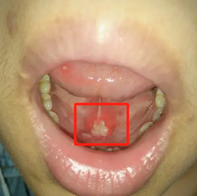 舌头根部溃疡吃什么药