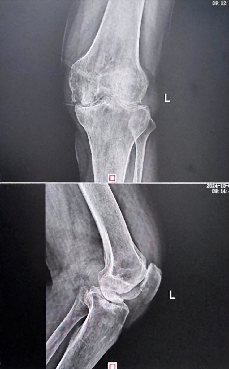 她患有左股骨头缺血性坏死以及双膝骨性关节炎,关节间歇性胀痛,活动后