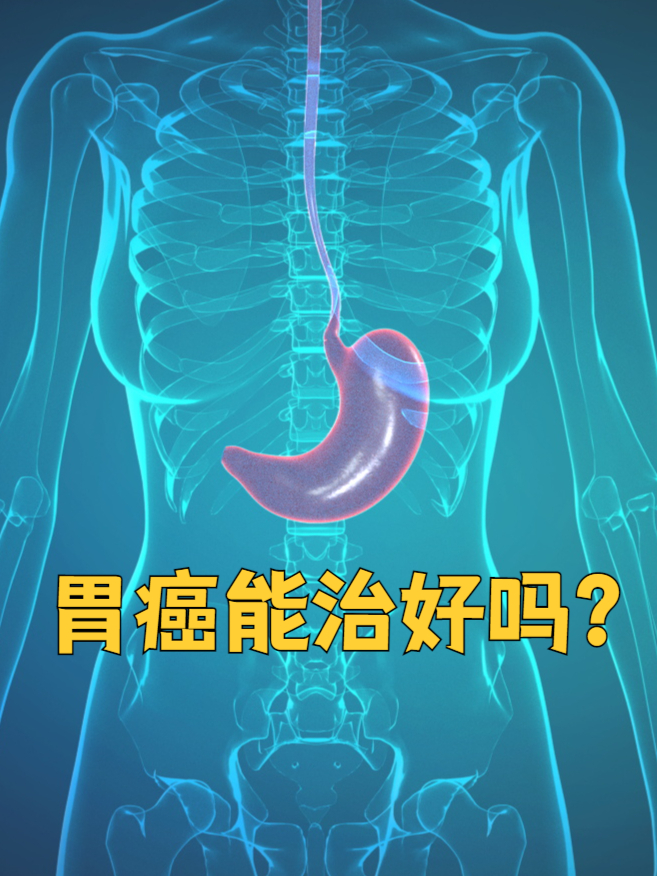 胃癌能治好吗?关键看分期与治疗!
