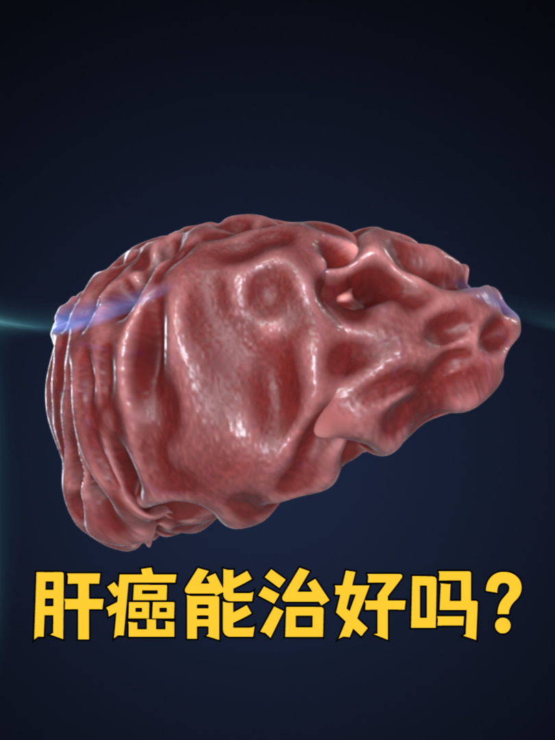 一,早期肝癌:治愈希望大 手术切除:早期