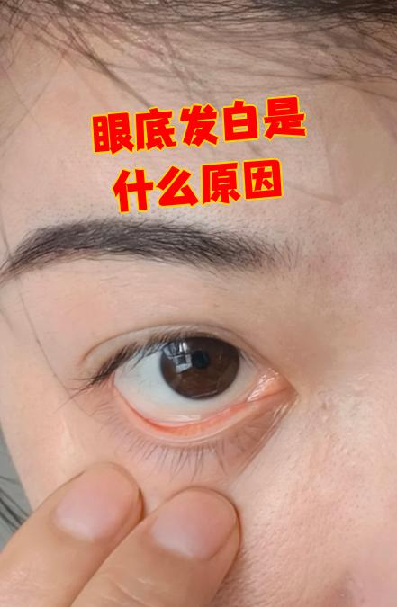 眼底发白可能由多种原因引起,主要包括视网膜