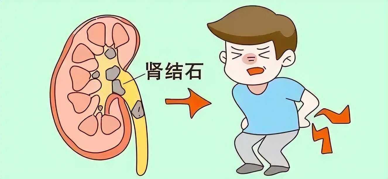 如果您的肾结石也不疼,正在纠结要不要治,请看此文给您专业答案