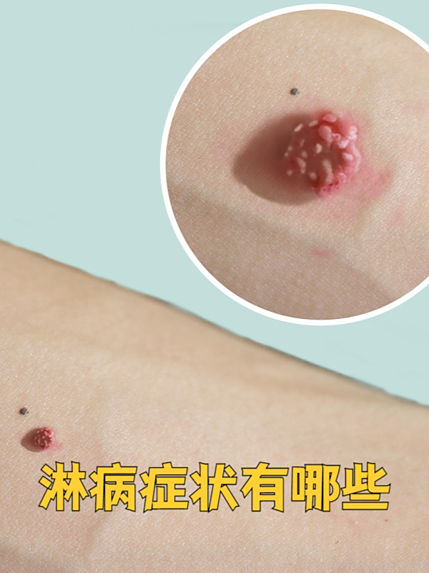 淋病是一种常见的性传播疾病,由淋球菌感染引起