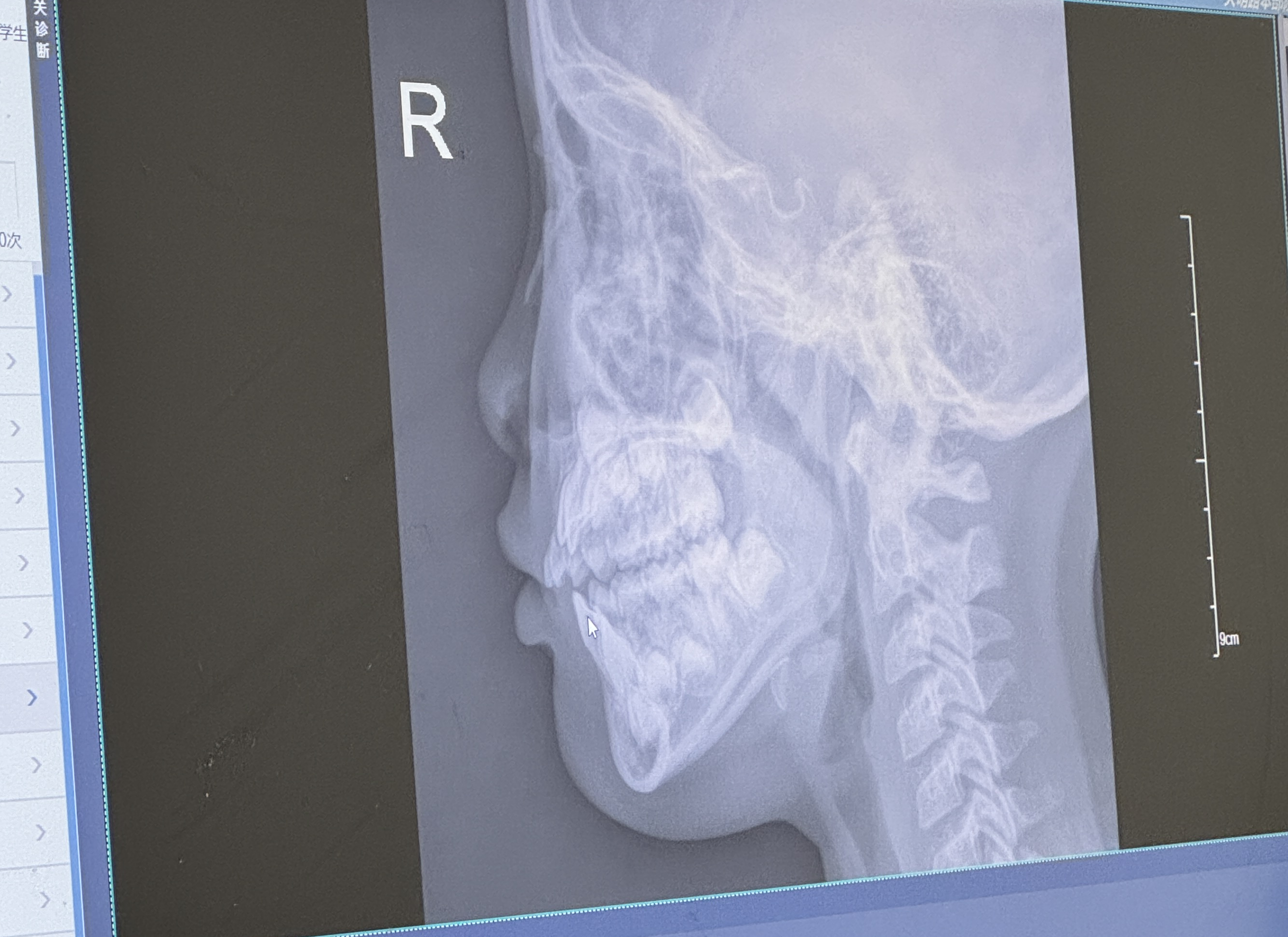 腺样体肥大别手术!中医揪出"痰湿"元凶,6种食物比消炎药管用!