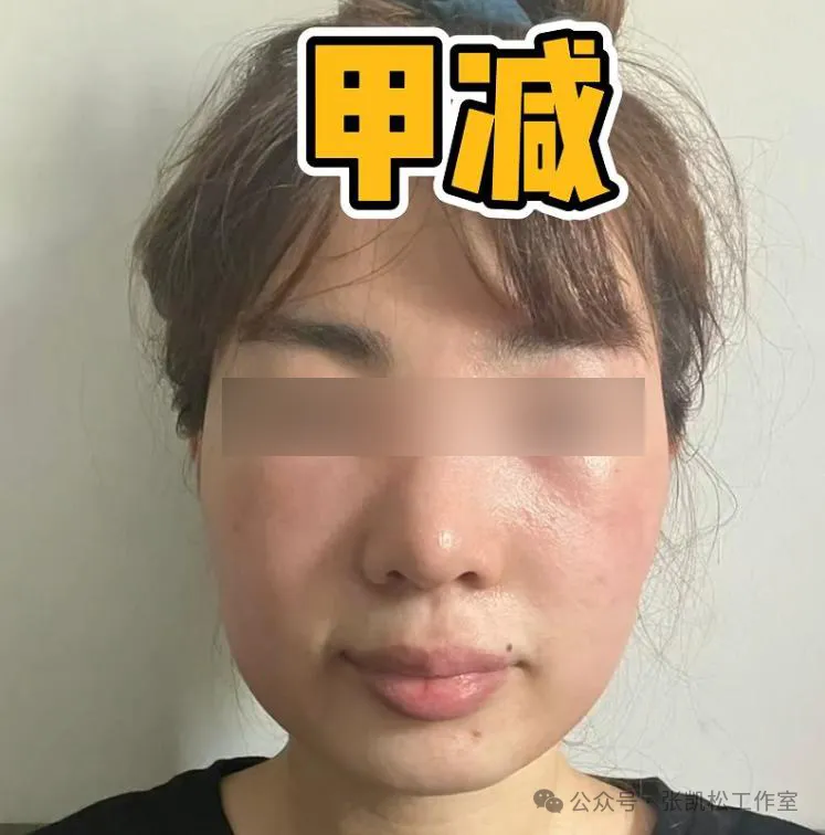 甲减脸上有这3个信号!超7成患者优甲乐量不足了,补救清单速领