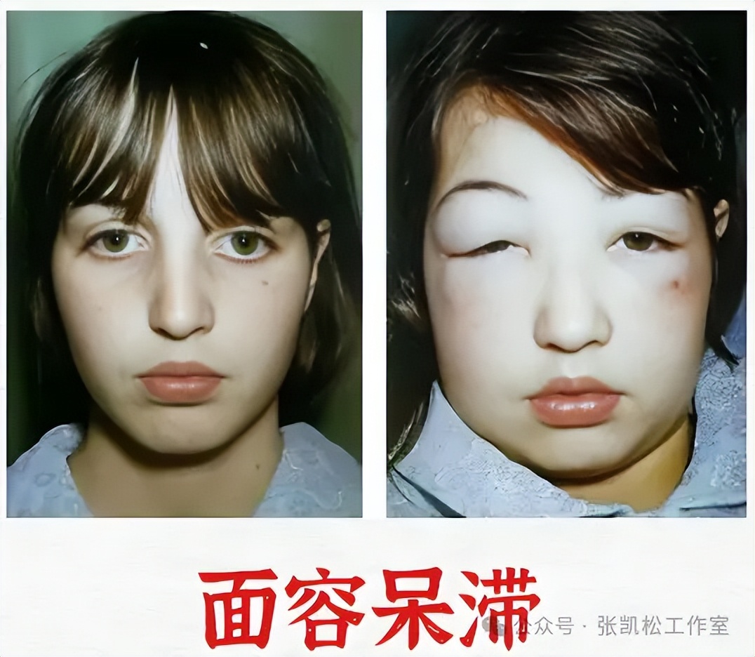 甲减脸上有这3个信号!超7成患者优甲乐量不足了,补救清单速领