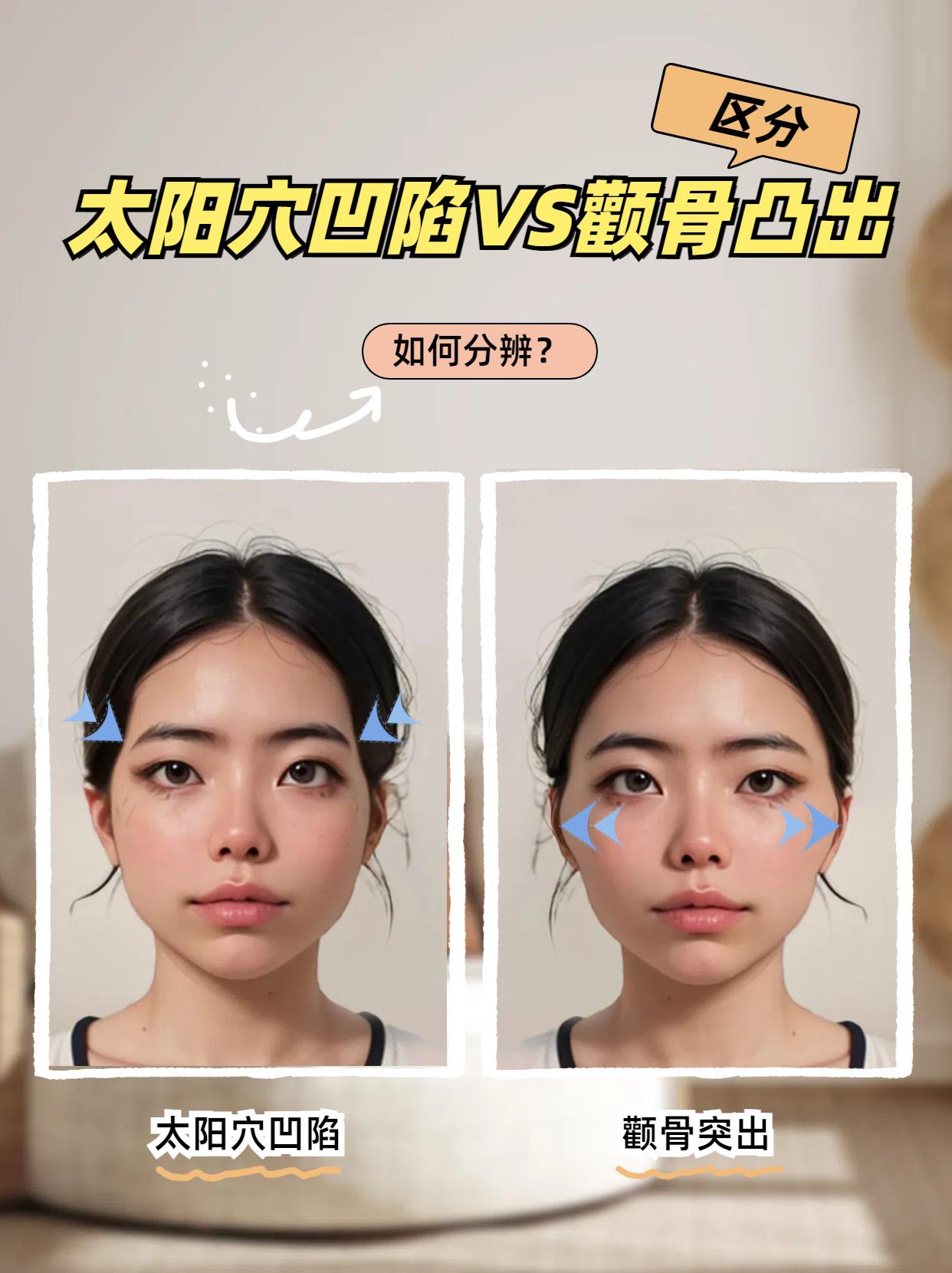 大家经常问,怎么区分自己是太阳穴凹陷还是颧骨突出?