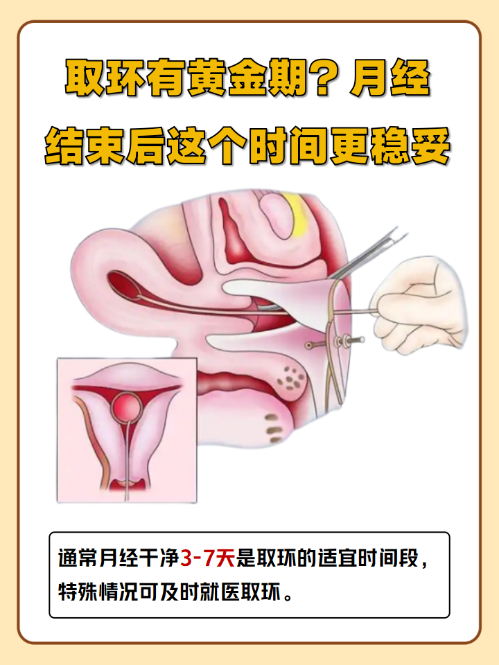 安舒环图片及寿命元宫环戴在子宫的图片取环米蕾娜节育环什么时候可以
