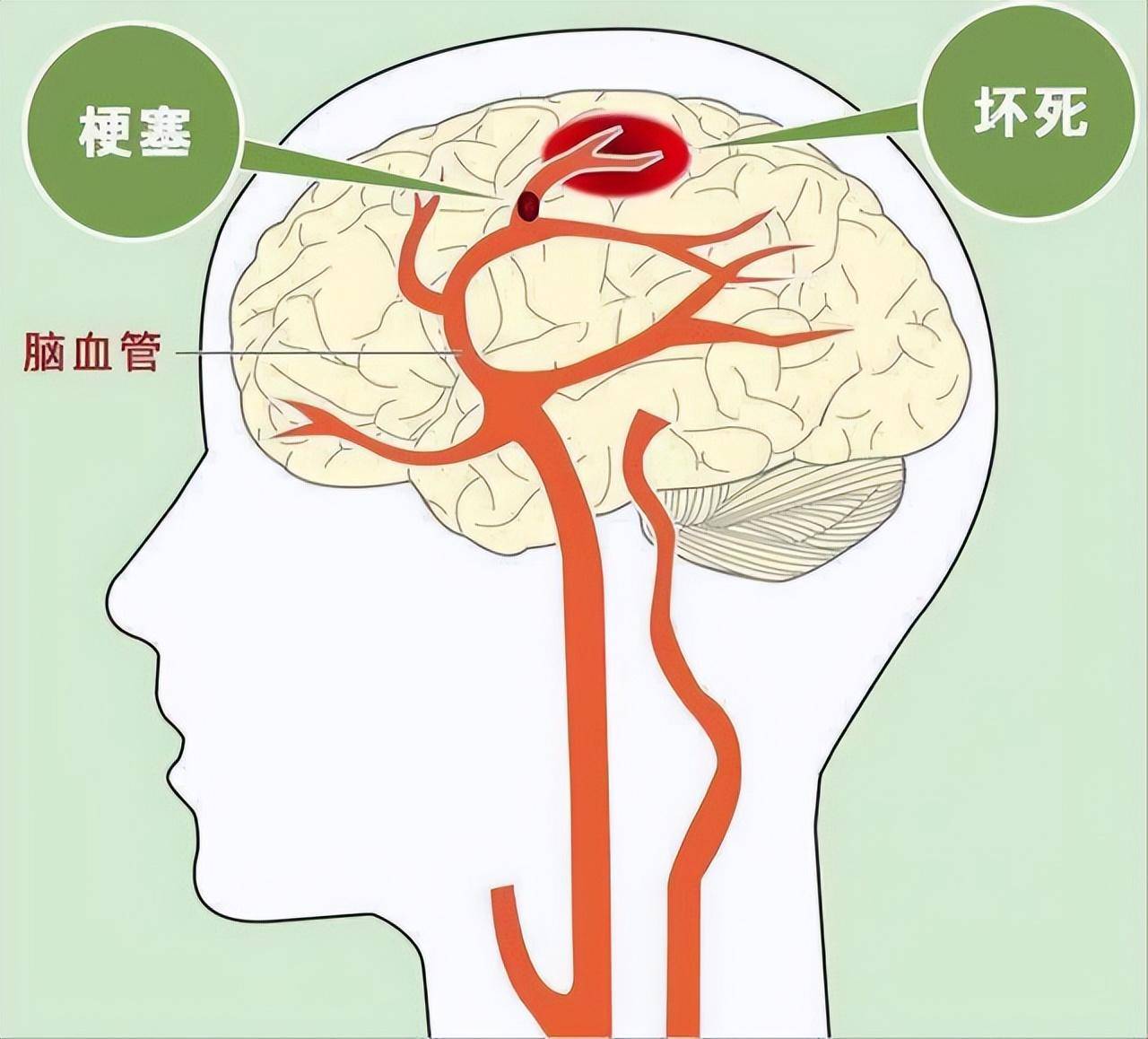 脑血管堵塞的5种症状