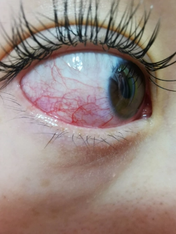 得了慢性结膜炎要注意什么?