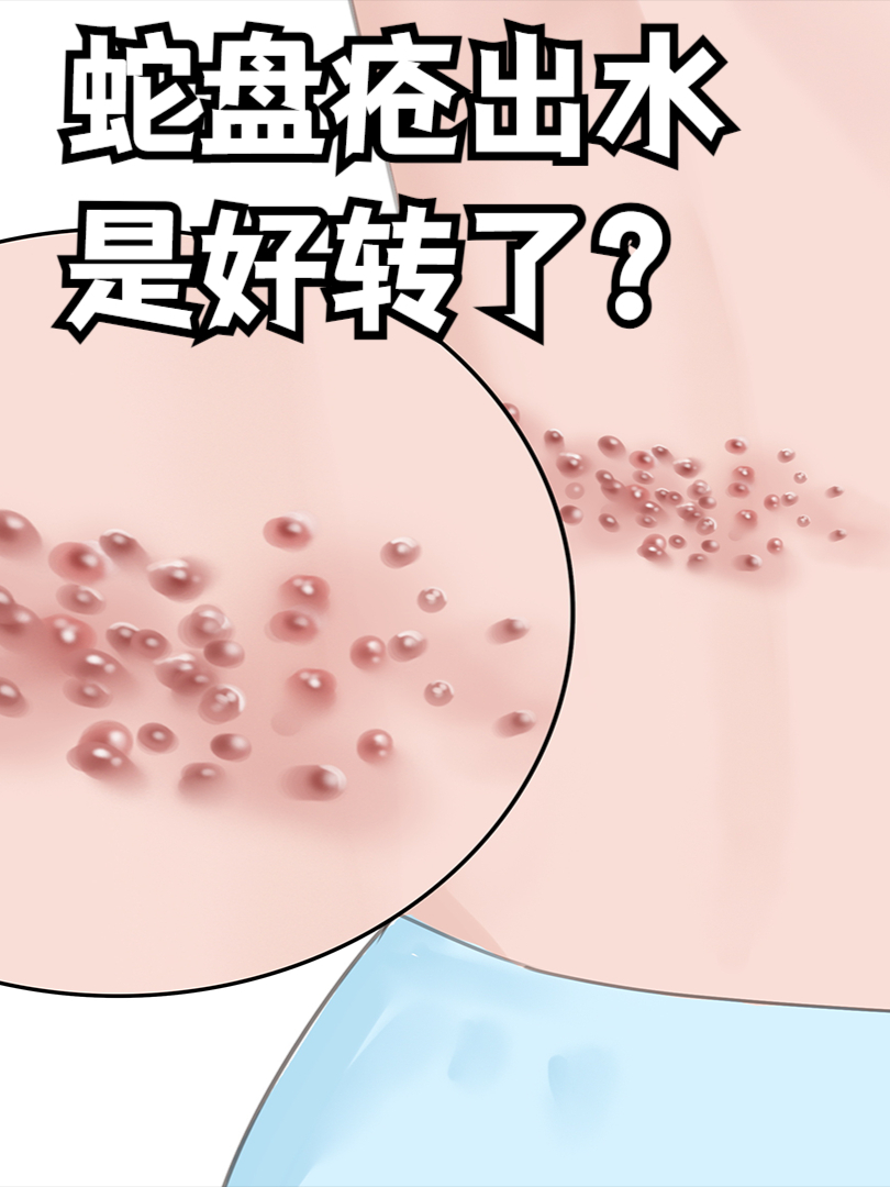 蛇盘疮出水了是好转了吗?