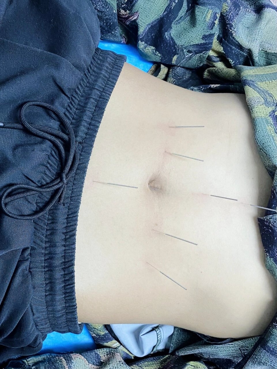 40岁女性术后闭经半年,中医揭秘卵巢早衰信号,针灸 膏方调理