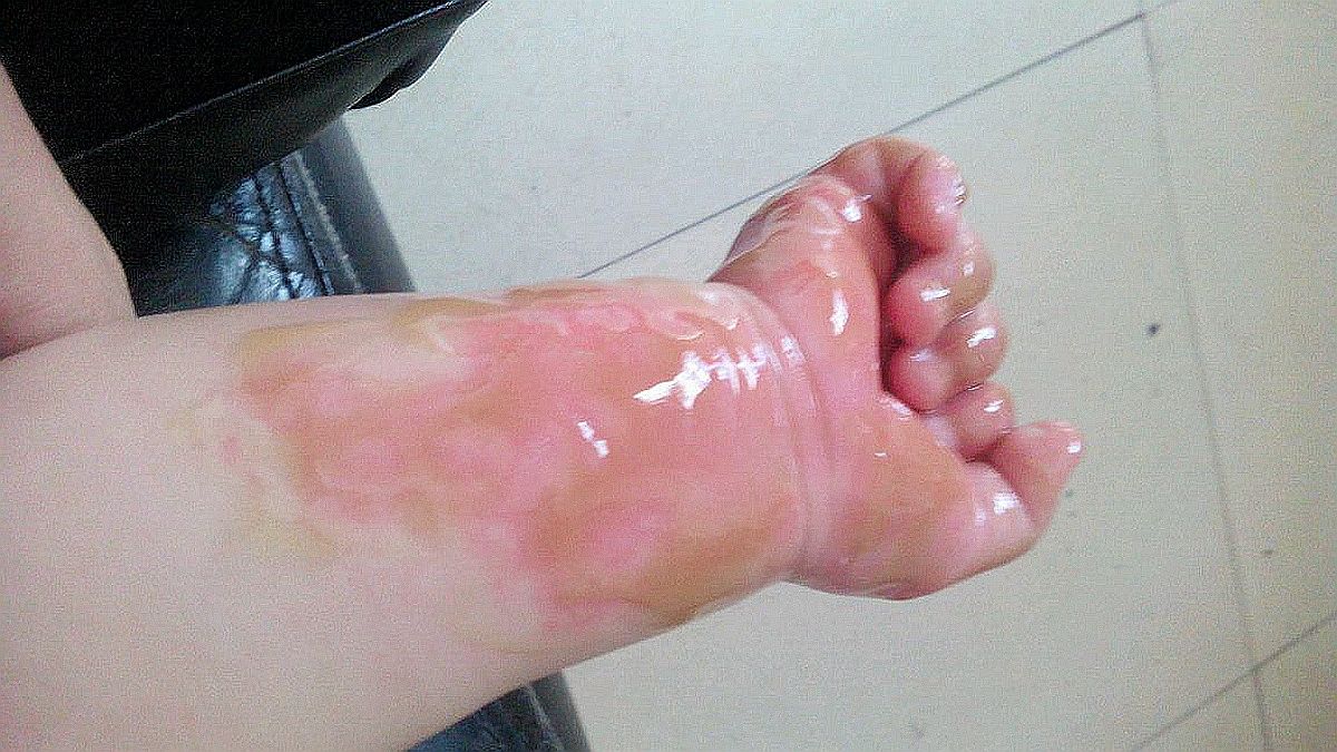 孩子被开水烫伤怎么办?牢记"五字诀"的处理方式,孩子能少受罪