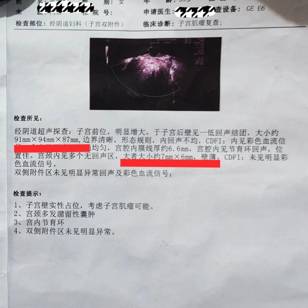 阴超报告老年女性阴超报告子宫厚唇肌瘤彩超图片浆膜下子宫肌瘤超声