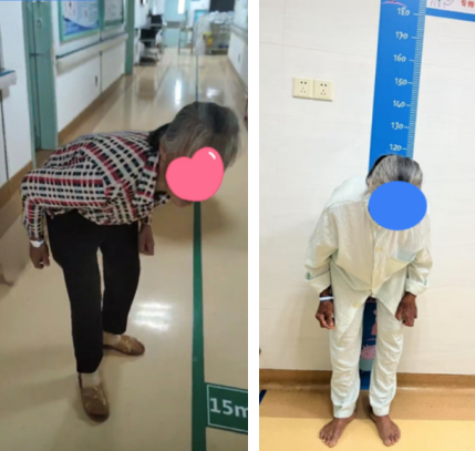 老驼背不是"老",是脊柱在求救!七旬"折角"阿姨术后重获挺拔