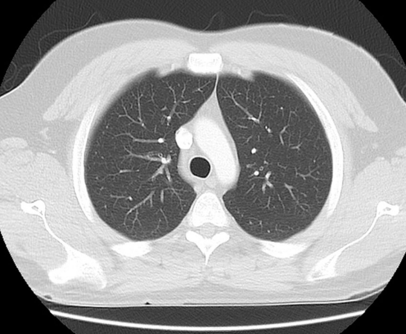 肺部ct肺ctct胸膜增厚怎么看工业肺ctct显示肺部陈旧病变肺纹理 ct