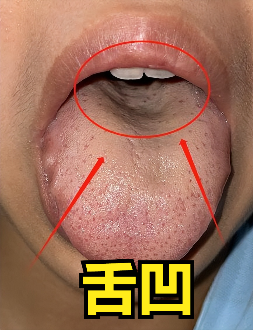 舌中凹陷别急着补,舌体鼓胀先别补肾