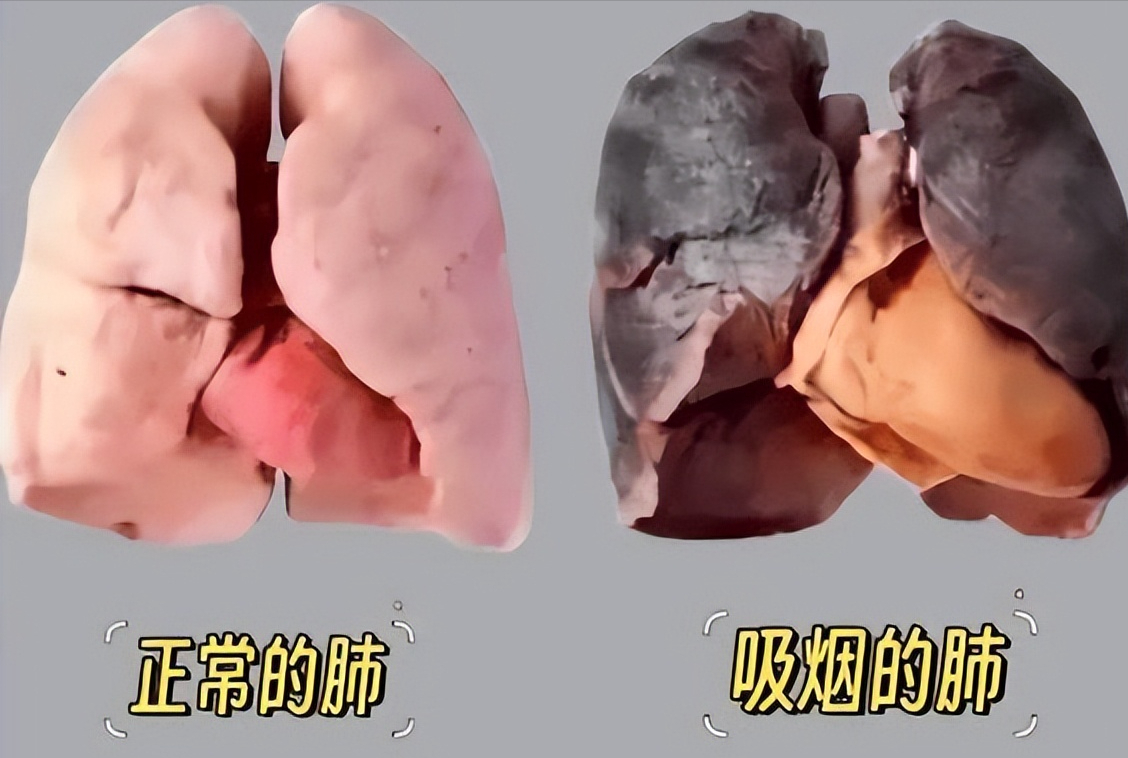 20年烟龄者的肺长什么样?戒烟后,变黑的肺还能白回来吗?