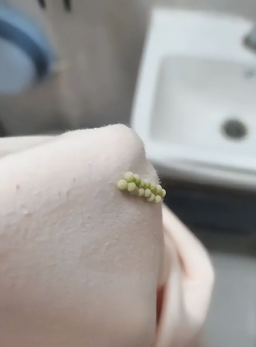 严打!四川女子觉得内衣硌肉,脱下一看,竟是一整排虫卵!