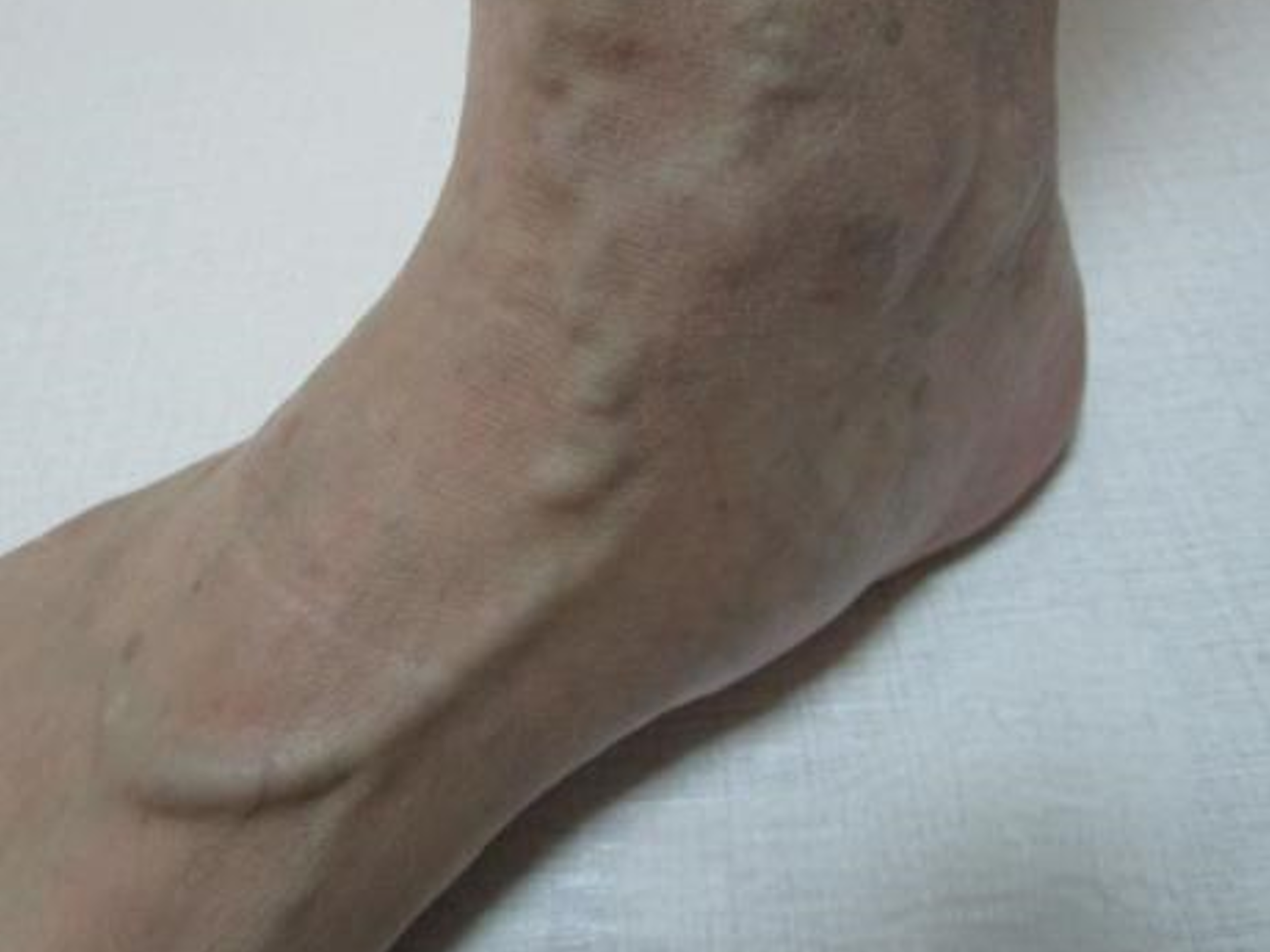 脚上的静脉曲张需谨慎处理,病根在上游,盲目治疗可能加重病情