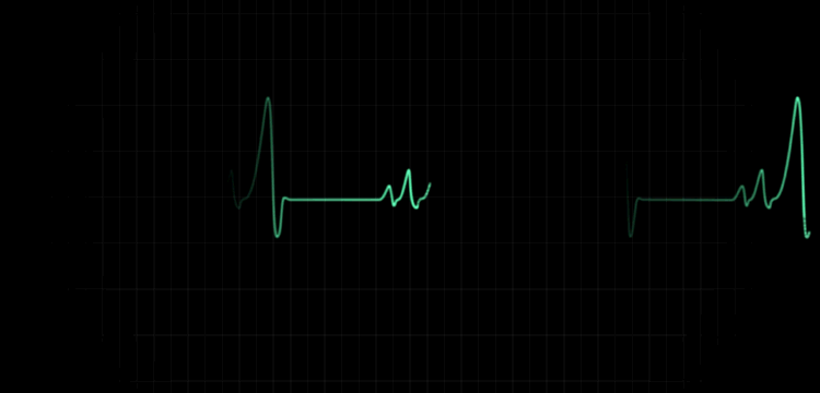 52岁大姐查出心律失常,6个月后心脏恢复正常,医生:做对了2件事