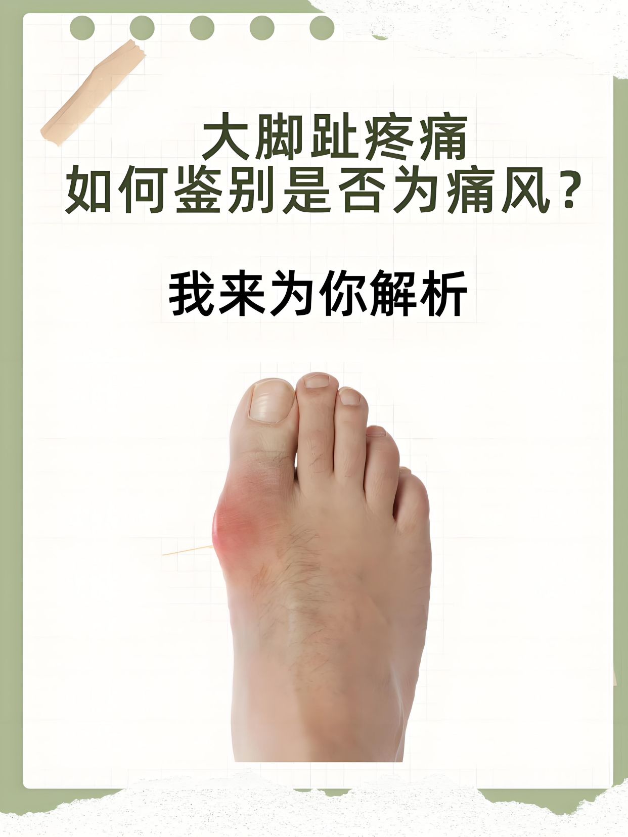 痛风第一跖趾关节图片痛风脚部位图片大全第一跖趾关节痛风图片脚趾头