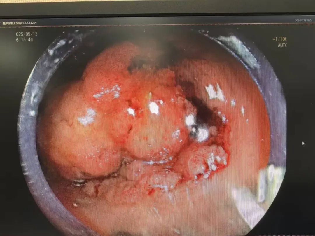 直肠肿瘤"镜"到病除,还能保肛!