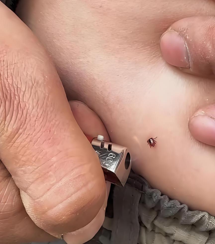 蜱虫钻孩子手臂,妈妈"三阻止"救了娃,医生:两招可自救