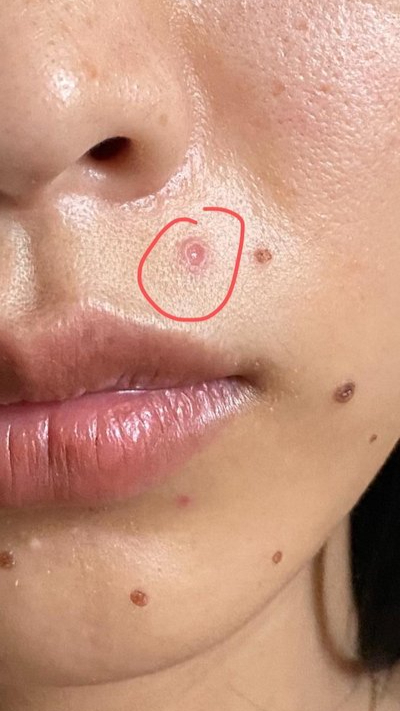 不建议使用此方法,建议去到专业的医院祛除,安全且无副作 药水点痣