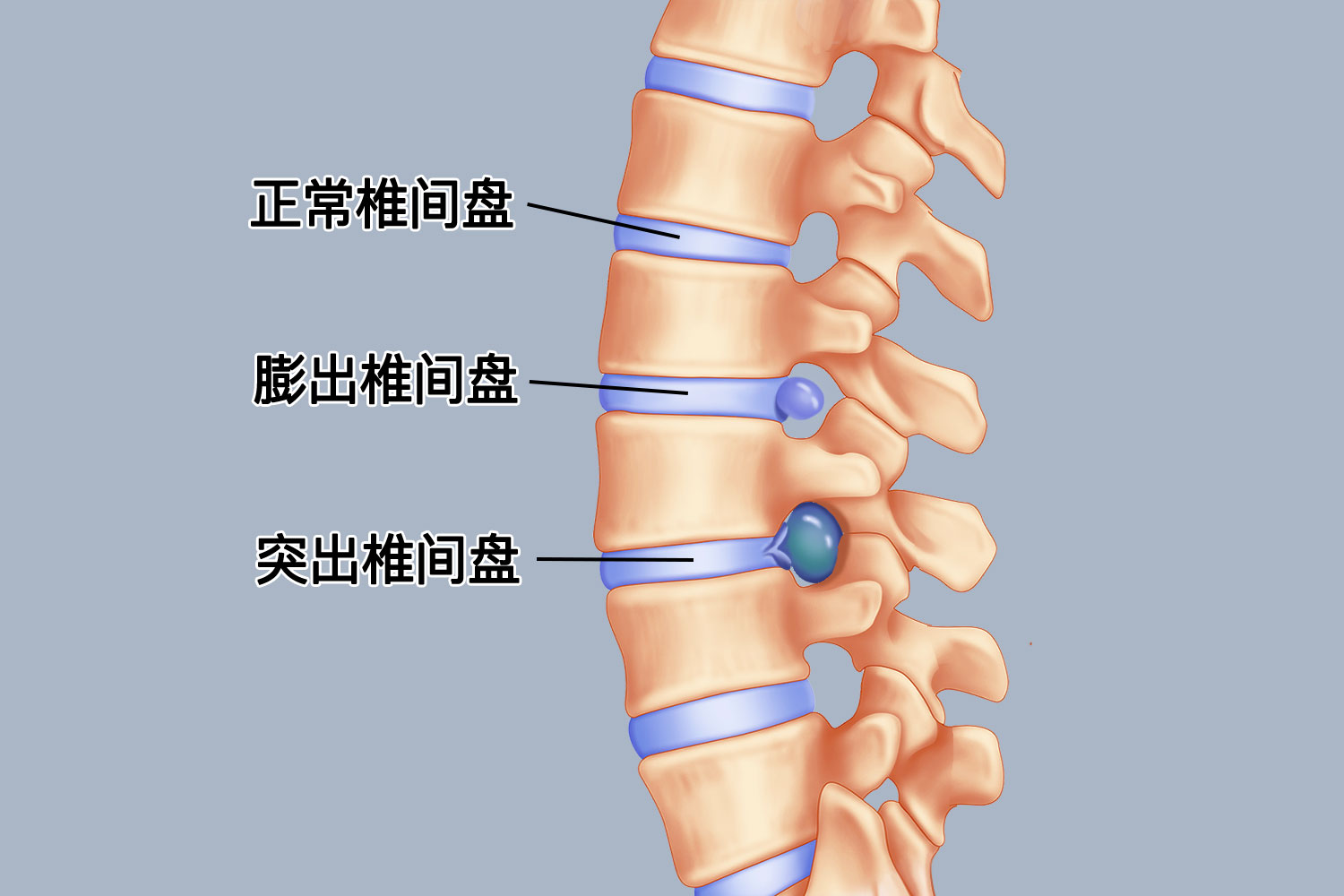 腰椎间盘突出疼痛?壮骨关节丸,骨刺消痛,舒筋活血片有何差异