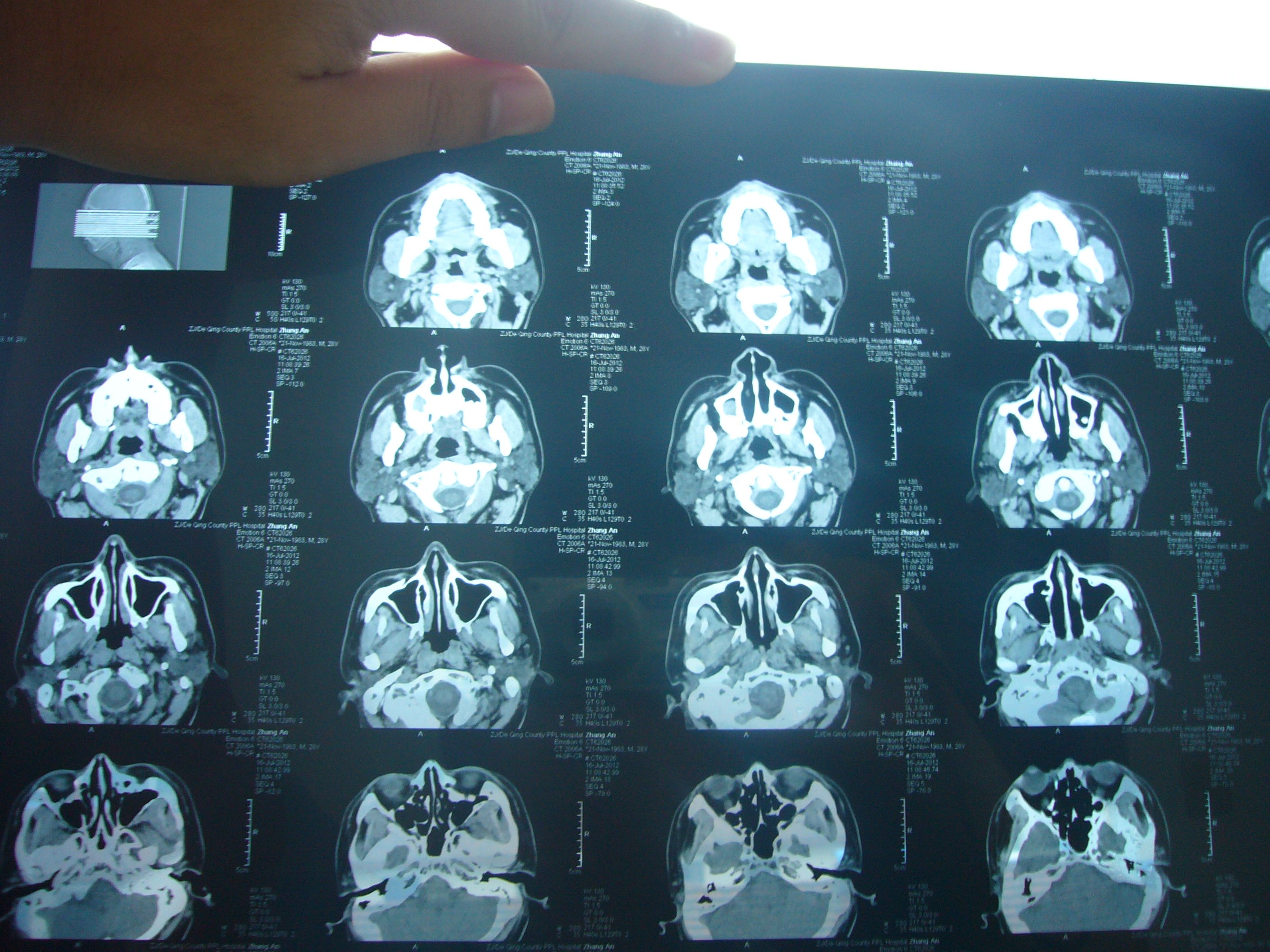 男子长期鼻塞,结果体检发现病情!叹息:早期情况太像感冒