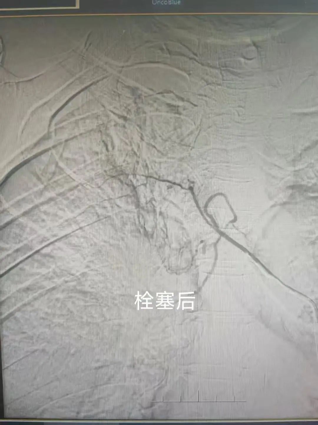 它不仅显著提升疗效更让治疗的痛苦大幅降低