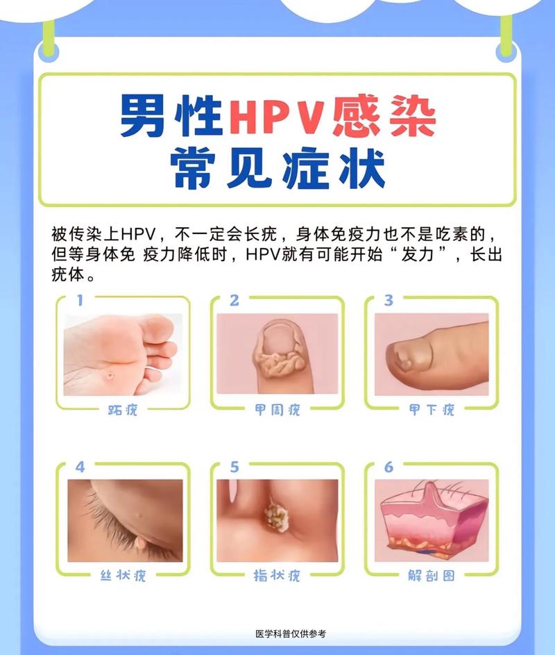 男性感染hpv多数没症状,部分人可能有症状