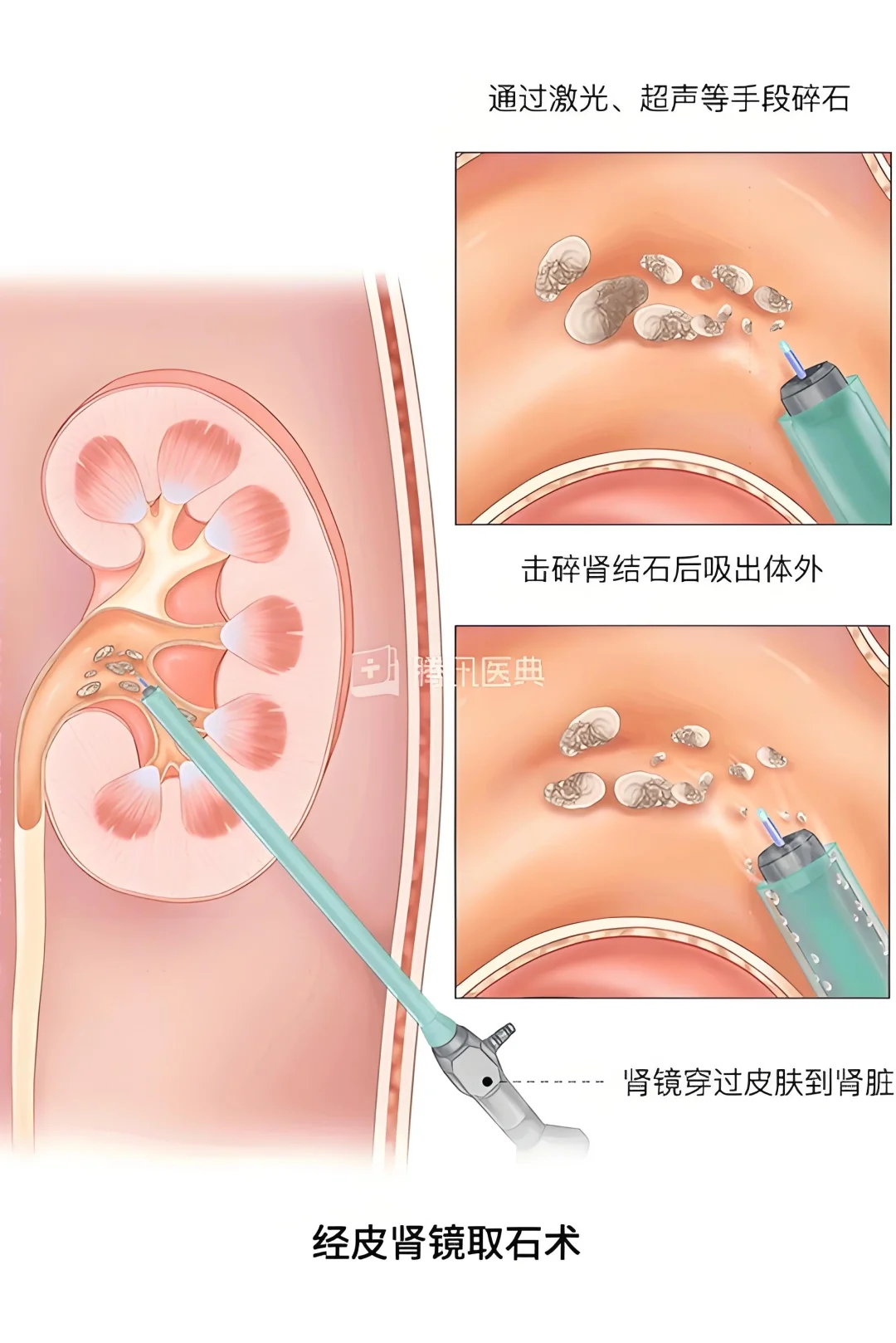 经皮肾镜碎石取石术是一种治疗肾结石等泌尿系统结石的方法