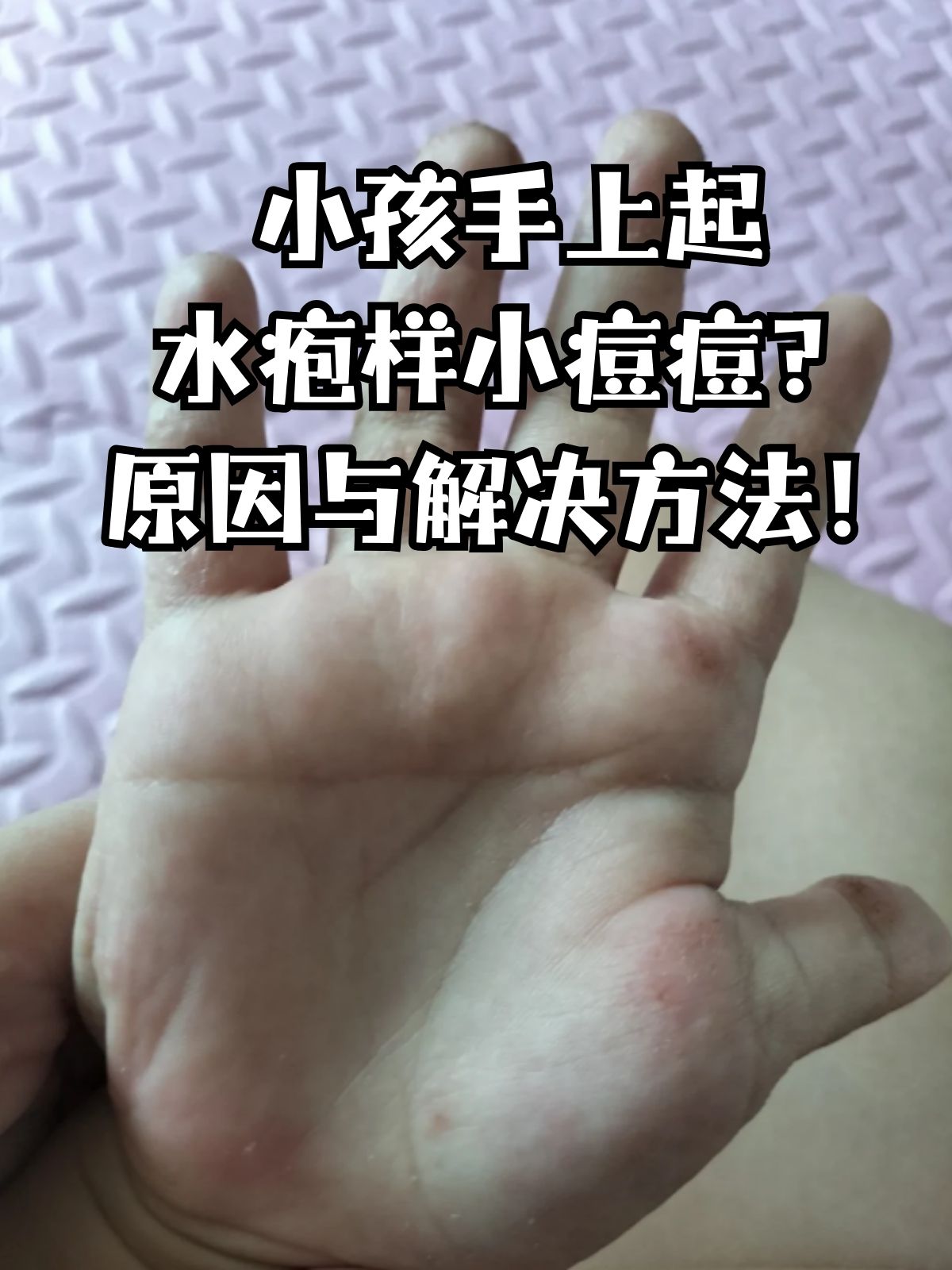 宝宝手上起像水泡一样的小疙瘩,可能是汗疱疹,跟出汗多有关;也可能